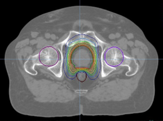 前立腺がんに対するIMRT