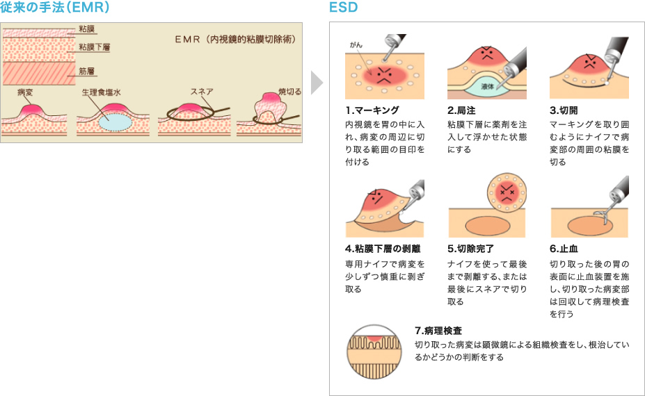 Esd 内視鏡的粘膜下層剥離術 先進的な医療 Feature 特集 取り組み 目指す姿 病院紹介 医療法人豊田会 刈谷豊田総合病院