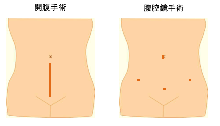 腫瘍 後 卵巣 手術