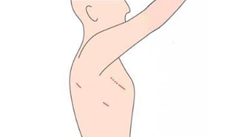 胸腔鏡手術の皮膚切開