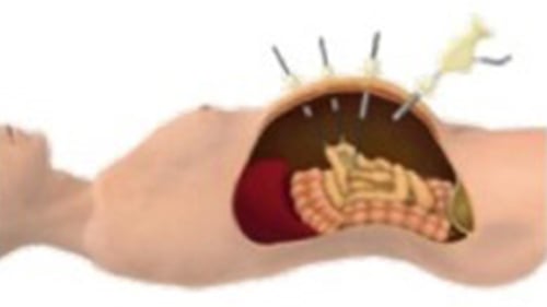 ロボット支援前立腺全摘除術(保険診療)01