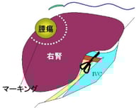 切除範囲の決定と腎動脈の遮断