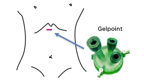呼吸器外科における胸腔鏡下手術08