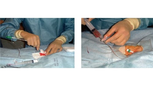 脳血管内手術 03