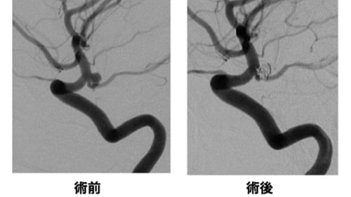 脳血管内手術 04