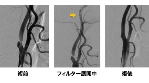 脳血管内手術 05
