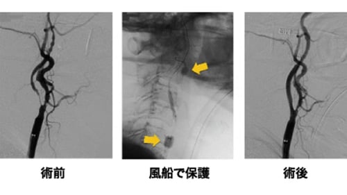 脳血管内手術 06