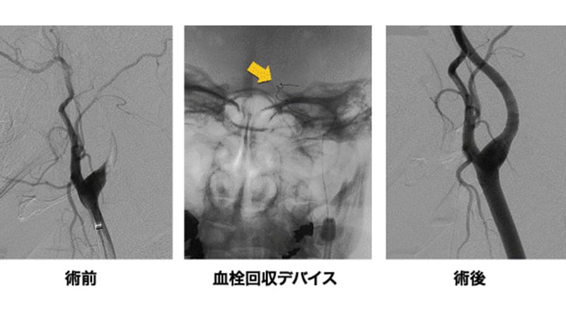 脳血管内手術 07