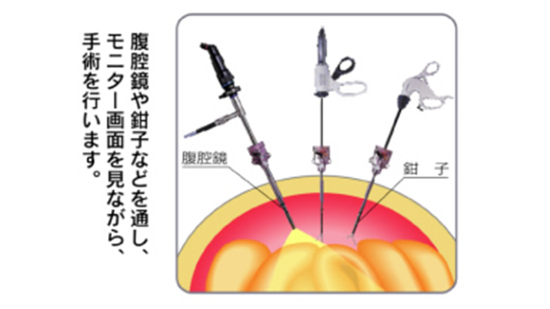 腹腔鏡下手術03