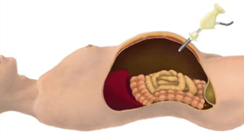 腹腔鏡下手術04