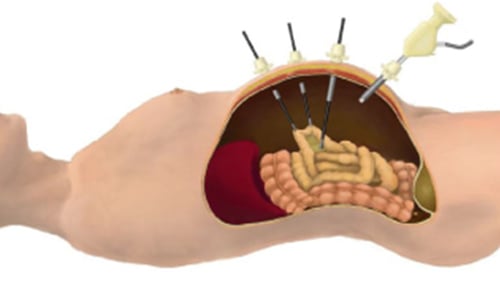 腹腔鏡下手術05