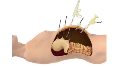 腹腔鏡下手術06