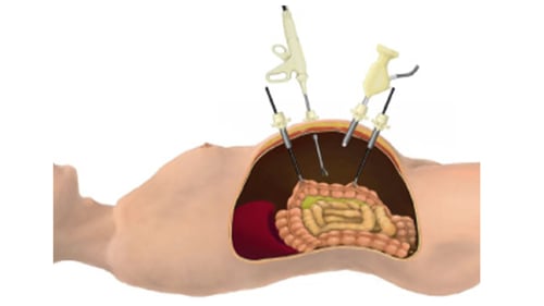 腹腔鏡下手術07