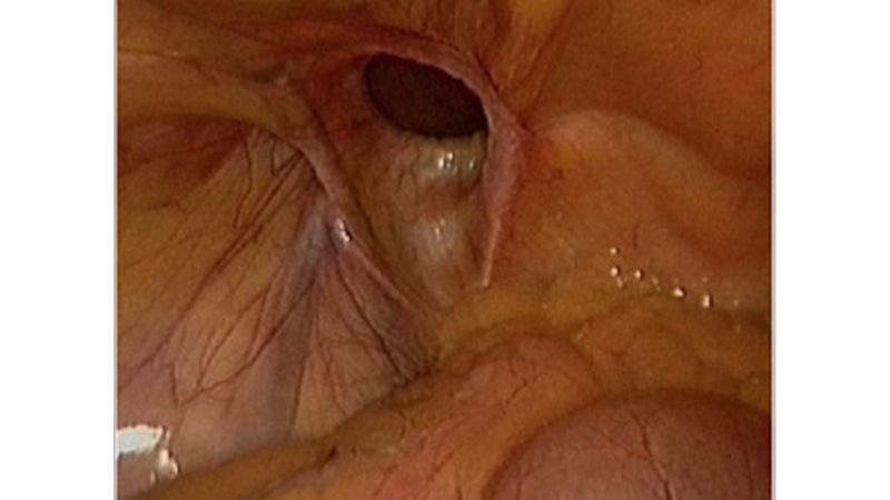 腹腔鏡下手術11