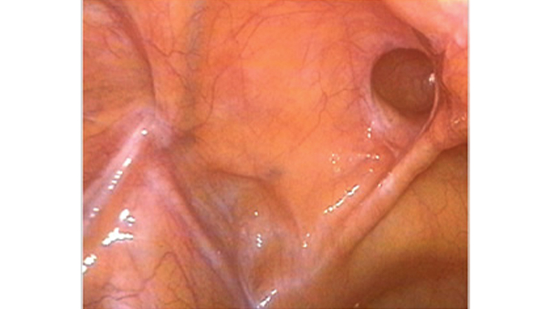 腹腔鏡下手術12