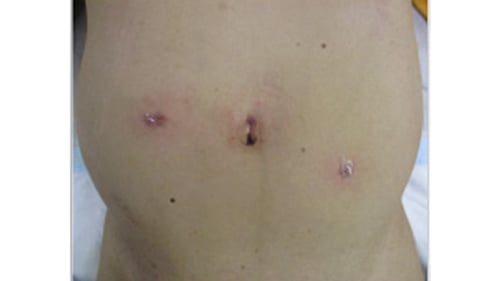 腹腔鏡下手術13