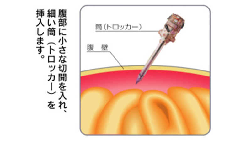 腹腔鏡下手術｜医療法人豊田会 刈谷豊田総合病院