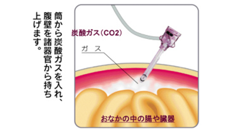 腹腔鏡下手術｜医療法人豊田会 刈谷豊田総合病院