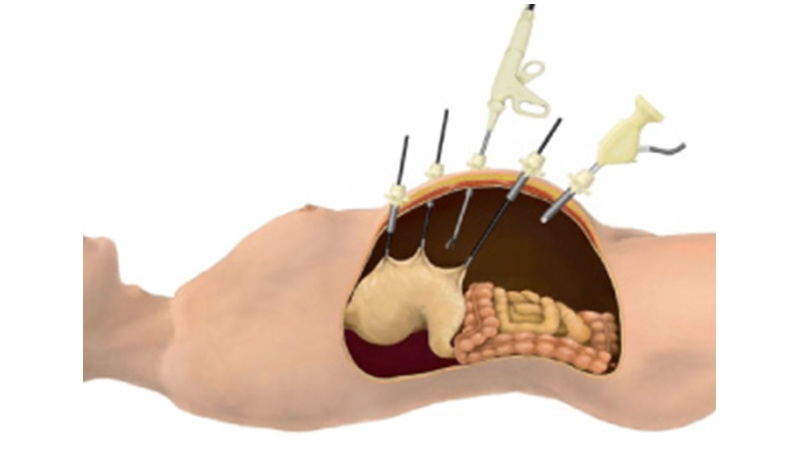 腹腔鏡下手術｜医療法人豊田会 刈谷豊田総合病院