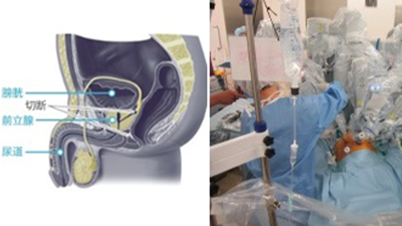 ロボット支援前立腺全摘除術（保険診療）｜医療法人豊田会 刈谷豊田