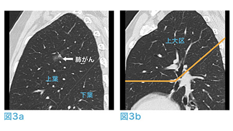 呼吸器外科手術 肺 呼吸器外科低侵襲手術[DVD付]: 基本テクニックから単孔式手術,ロボット